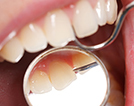3 歯周病改善・予防